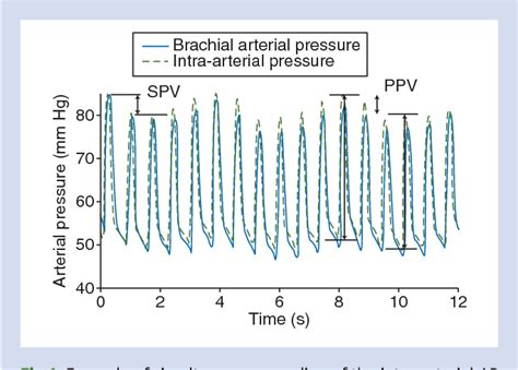 Image result for Pulse Pressure Variability
