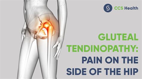 Could my hip pain be gluteal tendinopathy? - Central Coast Spinal Care ...