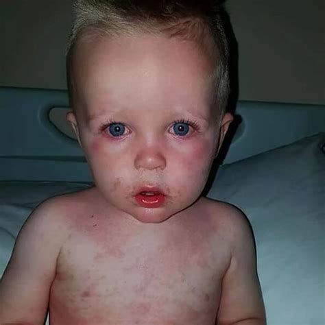 Kawasaki Disease Children