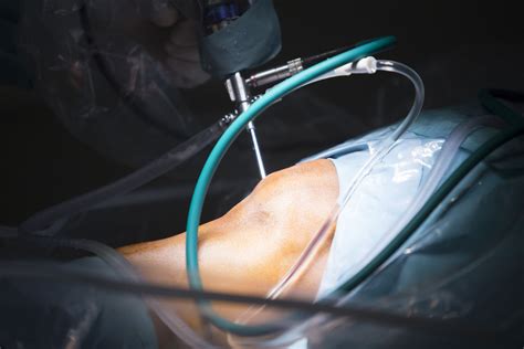 Arthroscopic Knee Surgery Meniscus Repair at Jane Mcgary blog