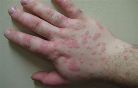 Janus Kinase Inhibitors effective in persistent erythema multiforme ...