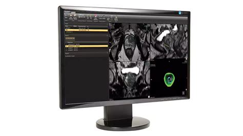 DynaCAD Prostate | Philips