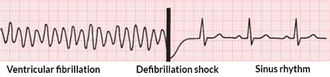Image result for Atrial Flutter Synchronized Cardioversion