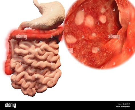 Image result for Colonoscopy Colitis