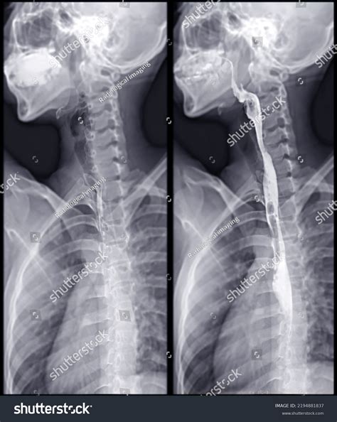 Barium Swallow Study Test Diagnose Barretts Stock Illustration 2194881837 | Shutterstock