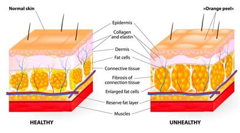 8 tips you need to reducing cellulite,The best method