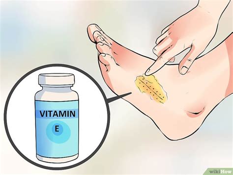Removing Sutures Step by Step 的图像结果