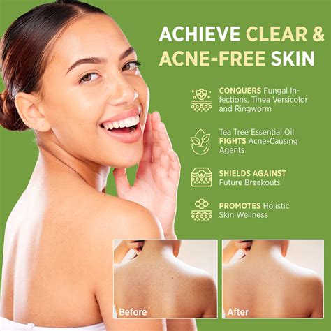 Buy Roycederm Antifungal Antibacterial Tea Tree Soap: Antifungal ...