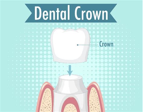 Tooth Crown Cement 的图像结果
