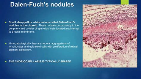SYMPATHETIC OPHTHALMIA & VKH SYNDROME | PPTX