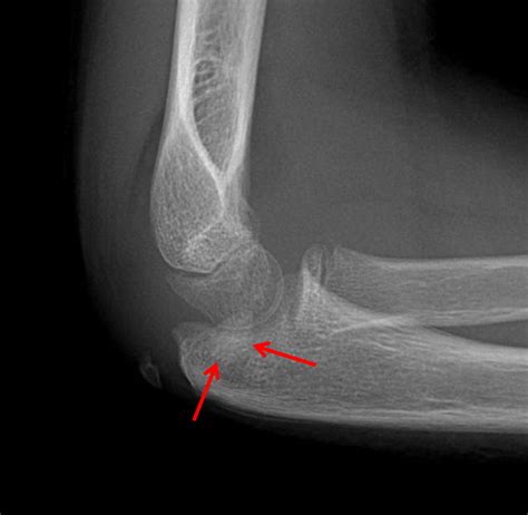 Medial Femoral Epicondyle