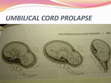 Umbilical Cord prolapse | PPTX