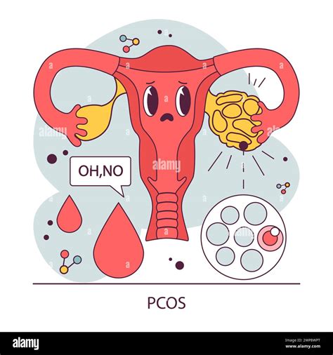 PCOS, polycystic ovary syndrome. Female reproductive system. Endocrine system organ disease ...