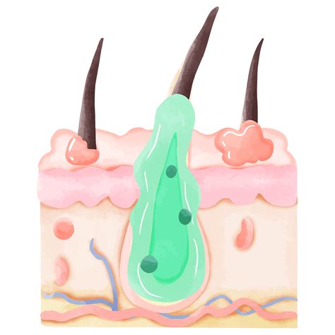 Watercolor Illustration of Inflamed Hair Follicle with Pus 48871050 PNG