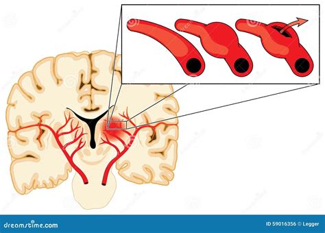 Cerebral aneurysm stock vector. Illustration of cerebrum - 59016356