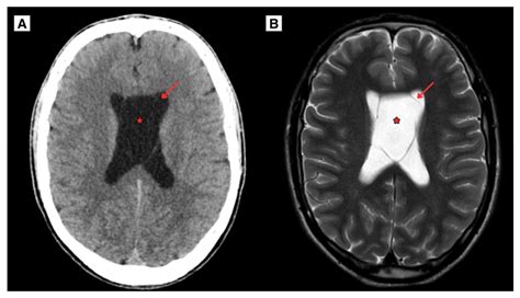 Symptomatic Cavum Septum Pellucidum and Vergae Cyst: A Case Report