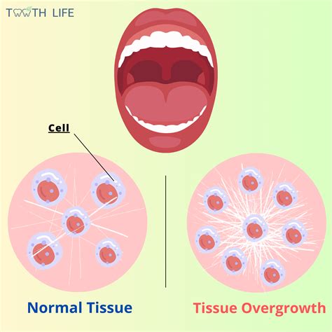Understanding Oral Fibromas: What's That Bump in Your Mouth?