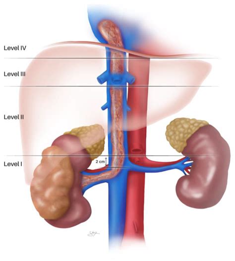 Open Surgical Management of Renal Cell Carcinoma with ...