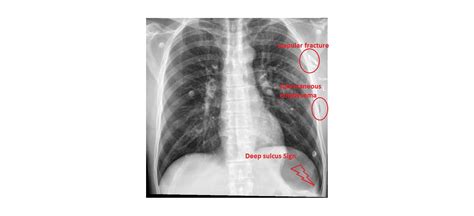 Image result for Deep Sulcus Sign