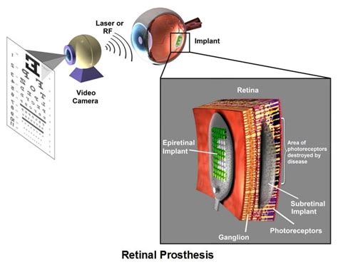 Image result for Visual Prosthesis Implant