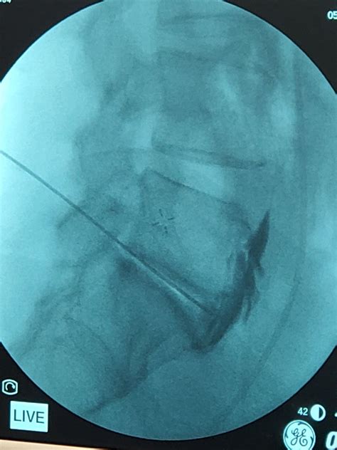 Biju . on LinkedIn: Radiofrequency ablation of superior hypogastric ...
