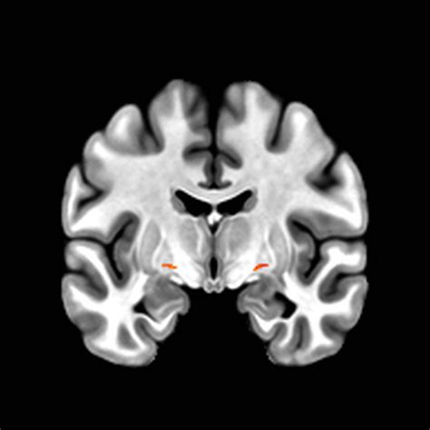 Nucleus Basalis of Meynert - AFNI Message Board - AFNI Discuss Message Board