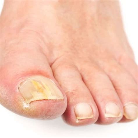 10ml Fungal Nail Treatment Liquid Highly Effective Kills Toe Fungus 期間限定