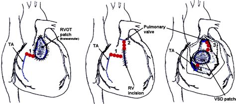 Ventricular Tachycardia Ablation in Adult Congenital Heart Disease ...