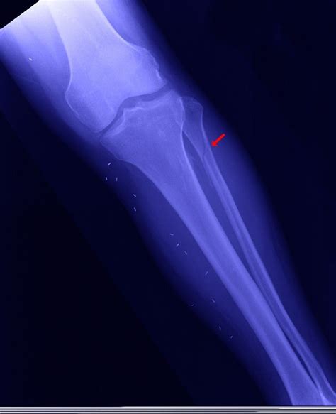 Image:Proximal Fibular Fracture-MSD Manual Professional Edition