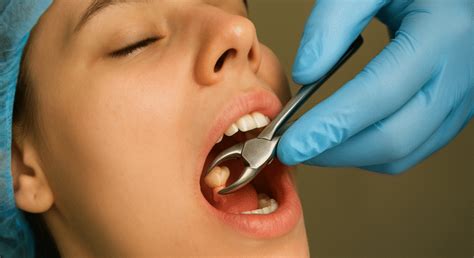 Wisdom Tooth Removal | Smile For All