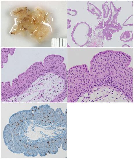 Bladder Neoplasia in Pediatric Patients—A Single-Center Experience ...
