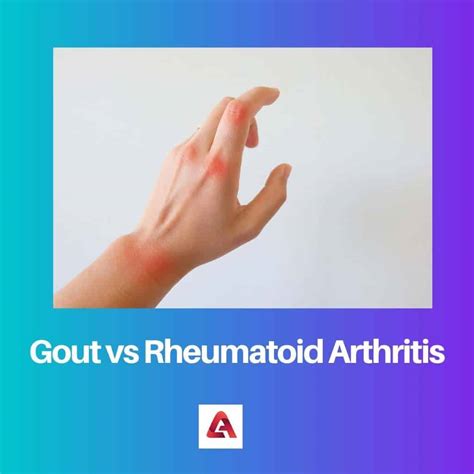 Gout vs Rheumatoid Arthritis: Difference and Comparison