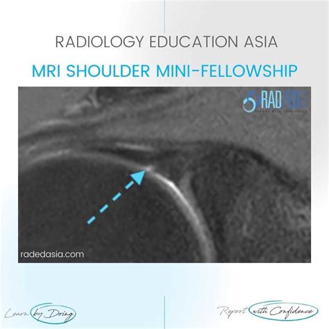 SHOULDER MRI BICEPS LABRUM JUNCTION: Q&A FROM THE COURSE - Radedasia