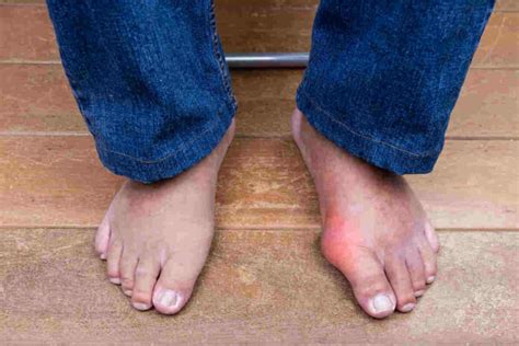 Can one live a normal life with gout?