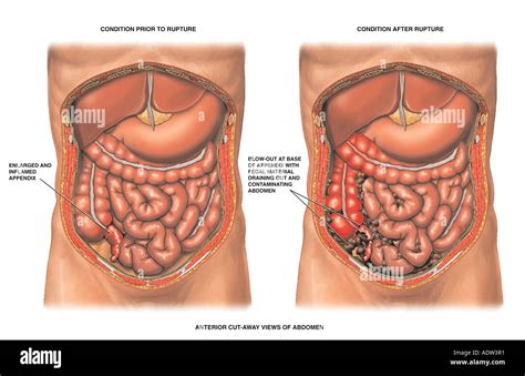 Image result for Perforated Appendix