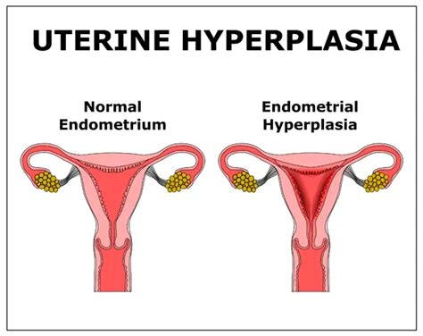 Hyperplasia Uterine Lining