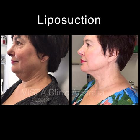 Lipo Lab Under Chin at Megan Lewis blog