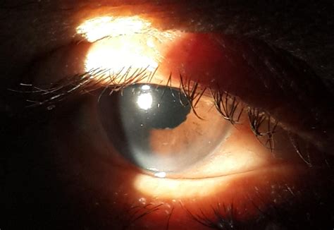 What Causes Posterior Cataracts at Debra Cunningham blog