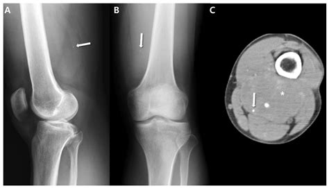What Does Sarcoma Look Like On X Ray