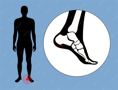 Anatomía del espolón calcaneal diagnóstico y tratamiento de problemas ...