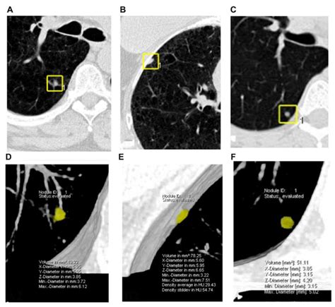 Intra- and Inter-Reader Variations in Lung Nodule Measurements ...
