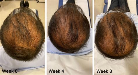 PRP Hair Loss Treatment - Diamond Skin Care