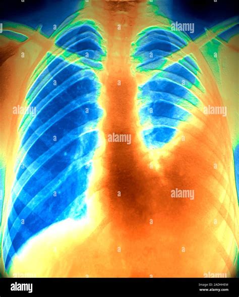 Pulmonary embolism. Coloured frontal X-ray of the chest of a patient ...