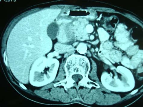 Pancreas Surgery Pictures, Images | LPC Mumbai