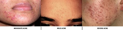 What causes Acne ?Symptoms ,Treatment with Images