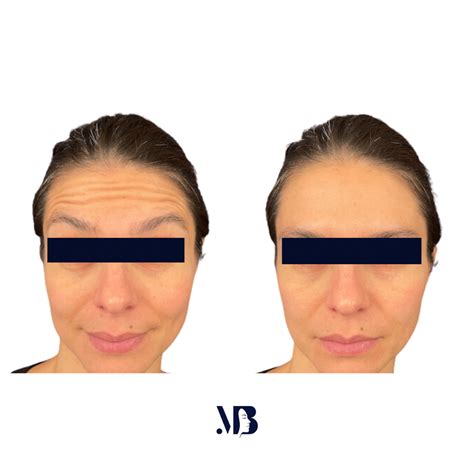 Botox injection for forehead wrinkles in Paris - Doctor Benoilid