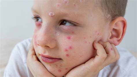 What is chickenpox and who can get the NHS vaccine? - BBC News