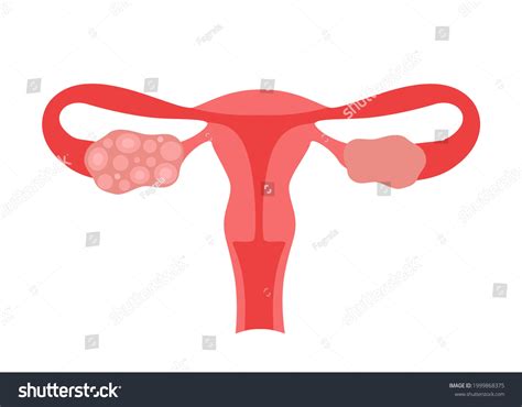 362 Ovarian Cyst Diagnosis Images, Stock Photos & Vectors | Shutterstock