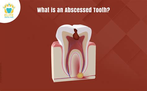 Extracting Abscessed Tooth 的图像结果