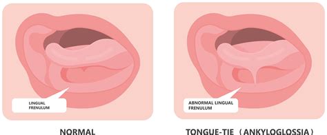 Tongue Tie - Colne Dental Care